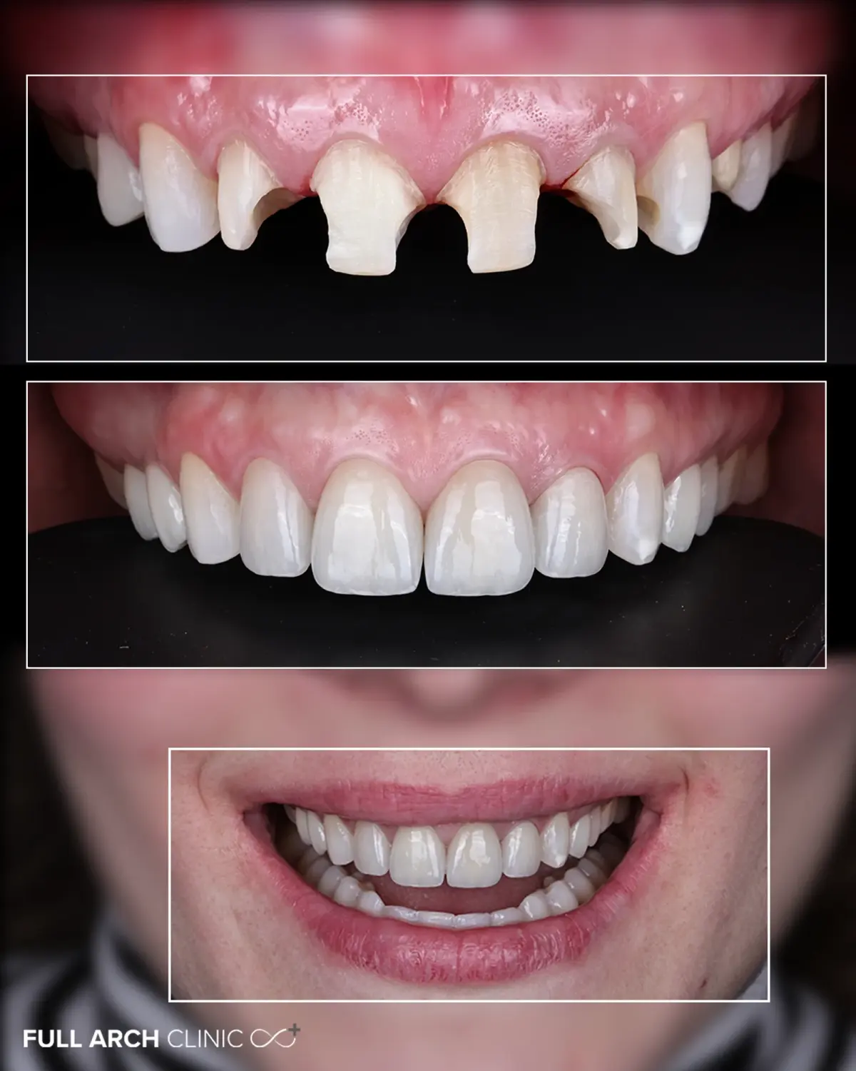 Înainte și după, șase dinți proprii reconstruiți cu coroane din ceramică stratificată și o coroană pe implant, la Full Arch Clinic