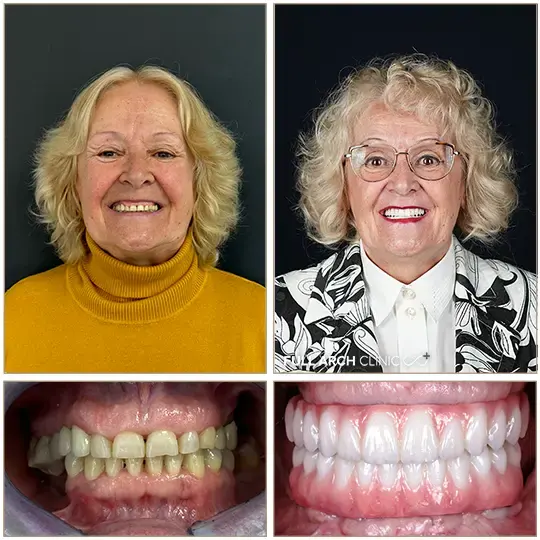 Înainte și după, reabilitare completă pe implanturi dentare, pacientă tratată la Full Arch Clinic
