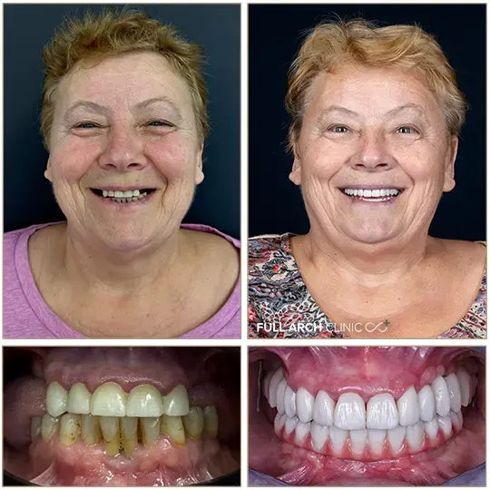 Înainte și după, reabilitare completă pe implanturi dentare, pacientă tratată la Full Arch Clinic