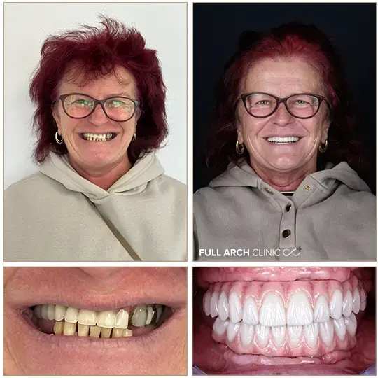 Înainte și după, dantură fixă pe implanturi dentare, pacient tratat la Full Arch Clinic