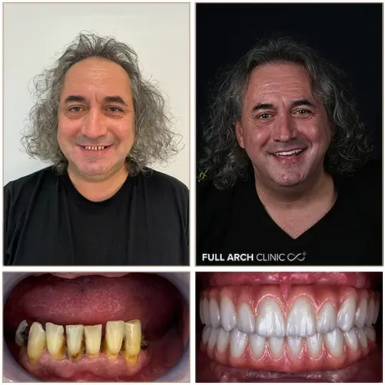 Înainte și după, reabilitare completă pe douăsprezece implanturi dentare, Full Arch Clinic
