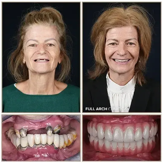 Înainte și după, reabilitare completă pe implanturi dentare, după lucrări vechi care au cedat