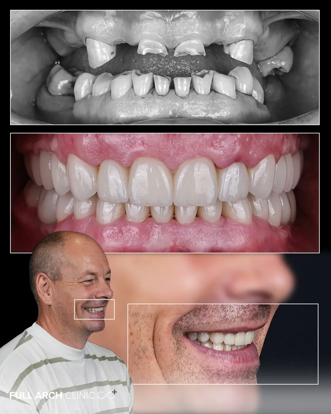 Înainte și după, dinții în gură, apoi zâmbetul în profil cu detaliul lucrării pe dinții proprii și pe implanturi dentare