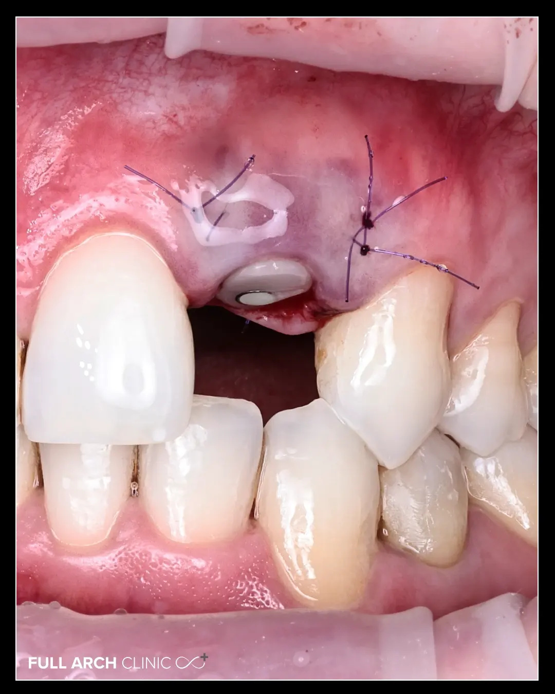 Implant dentar individual cu bont de vindecare individualizat și grefă gingivală, în ziua inserării, cu firele de sutură pe loc