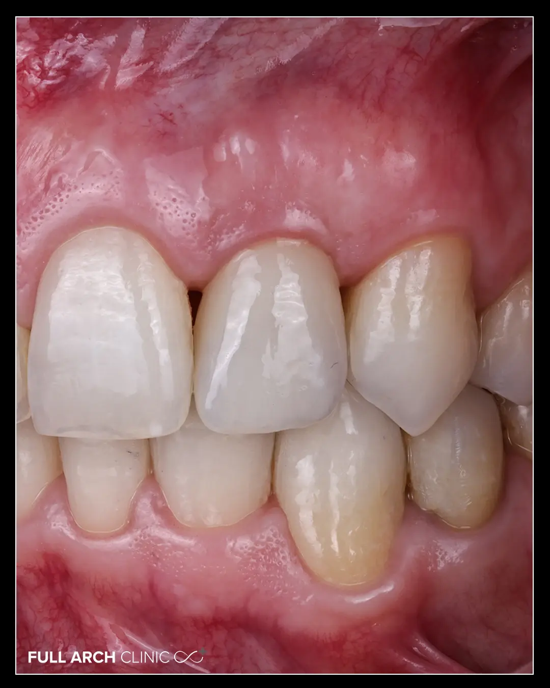 Coroana pe implant, fixată, alături de dinții naturali vecini