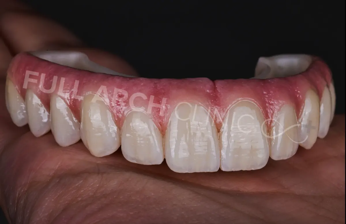 Prim-plan pe o lucrare finală din ceramică stratificată, prezentată pe bara de titan, cu trecerea dintre gingie și dinți