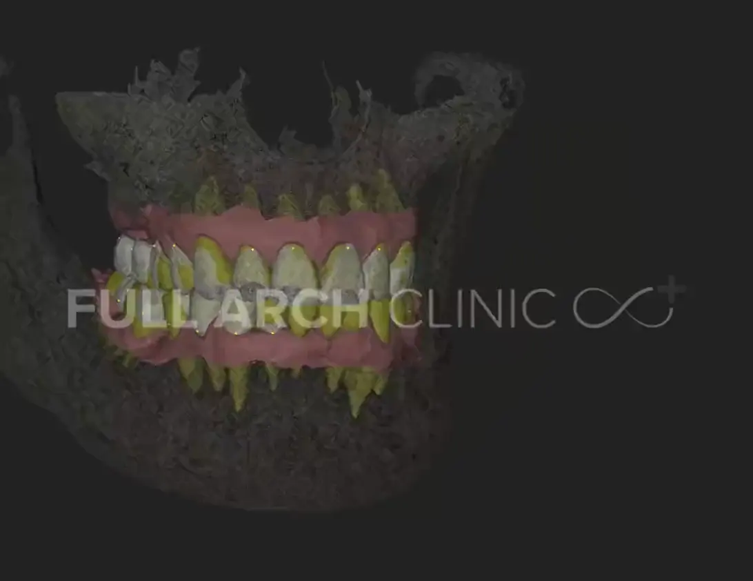 Modelul 3D al unui caz, rotit în jurul axei, cu osul din radiografia 3D și cu dinții din scanarea intraorală suprapuși