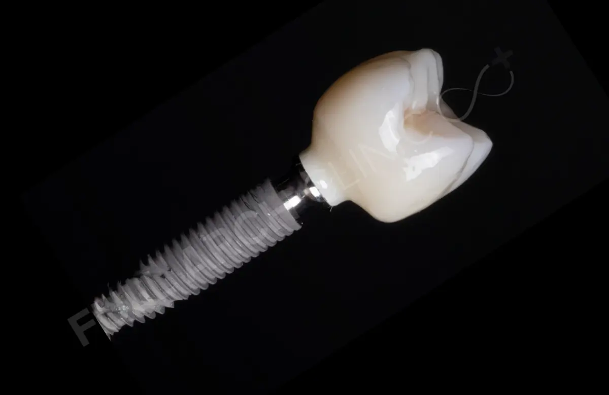 Un implant dentar și coroana ceramică individuală fixată pe el, fotografiate pe fundal negru