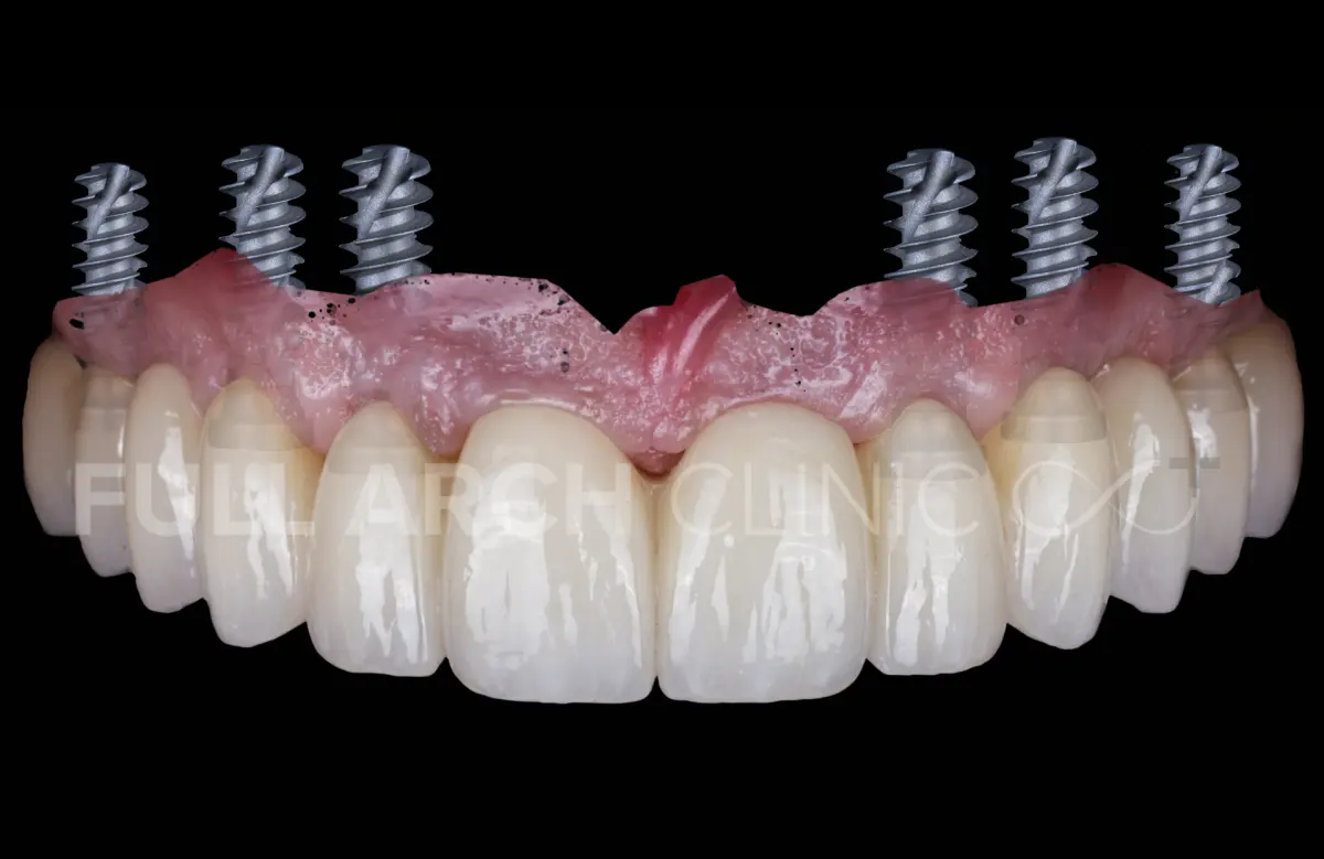 Lucrare fixă fără gingie artificială, fotografiată cu implanturile sub ea, care arată că lucrarea reface doar dinții
