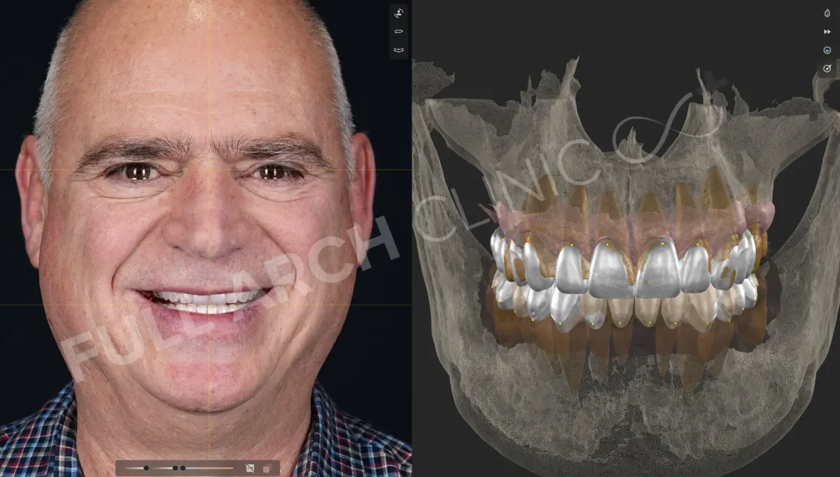 Planul digital al unui caz, cu fotografia feței aliniată pe radiografie 3D și cu forma dinților proiectată peste dinții existenți