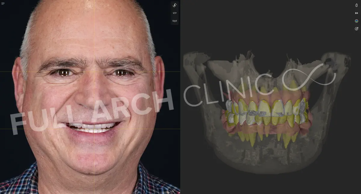 Platforma de planificare 3D: fotografia feței pacientului în stânga, iar în dreapta scanarea intraorală suprapusă pe radiografia 3D, cu dinții și osul văzute împreună