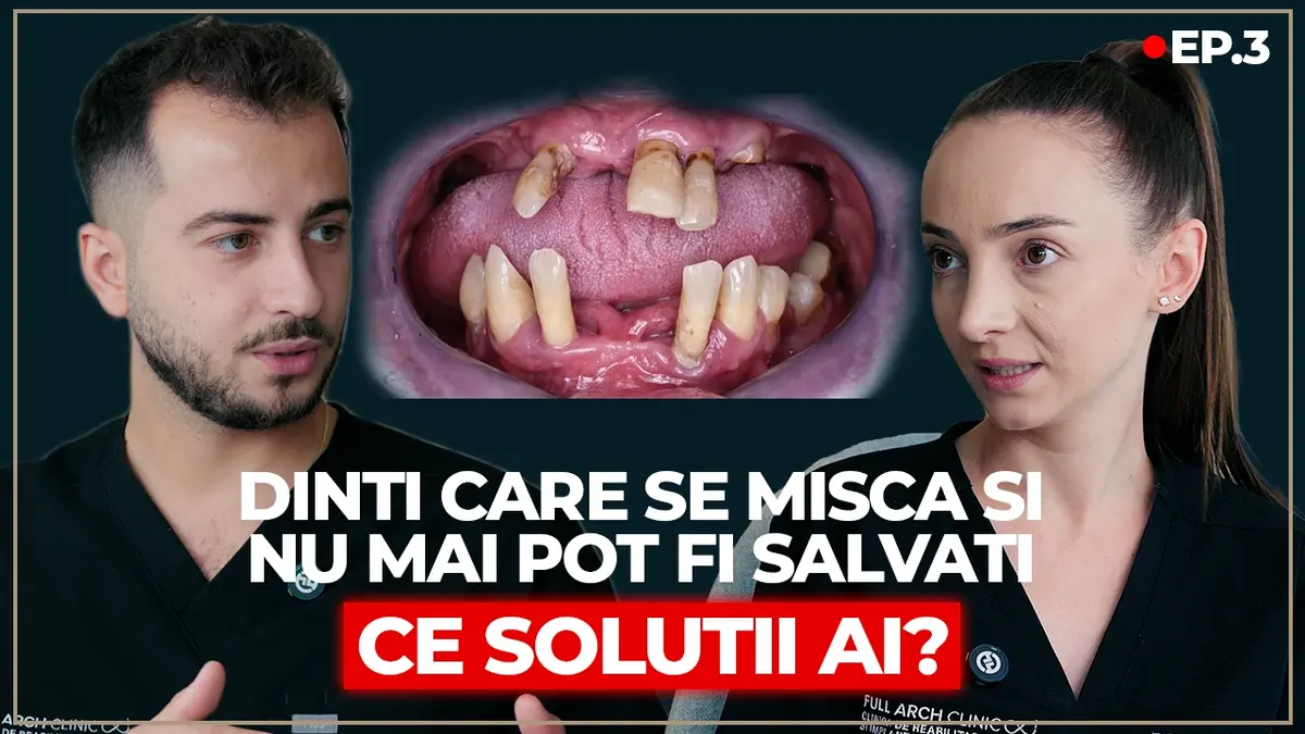 Când dinții nu mai pot fi salvați: dantură fixă pe 8 implanturi după boala parodontală