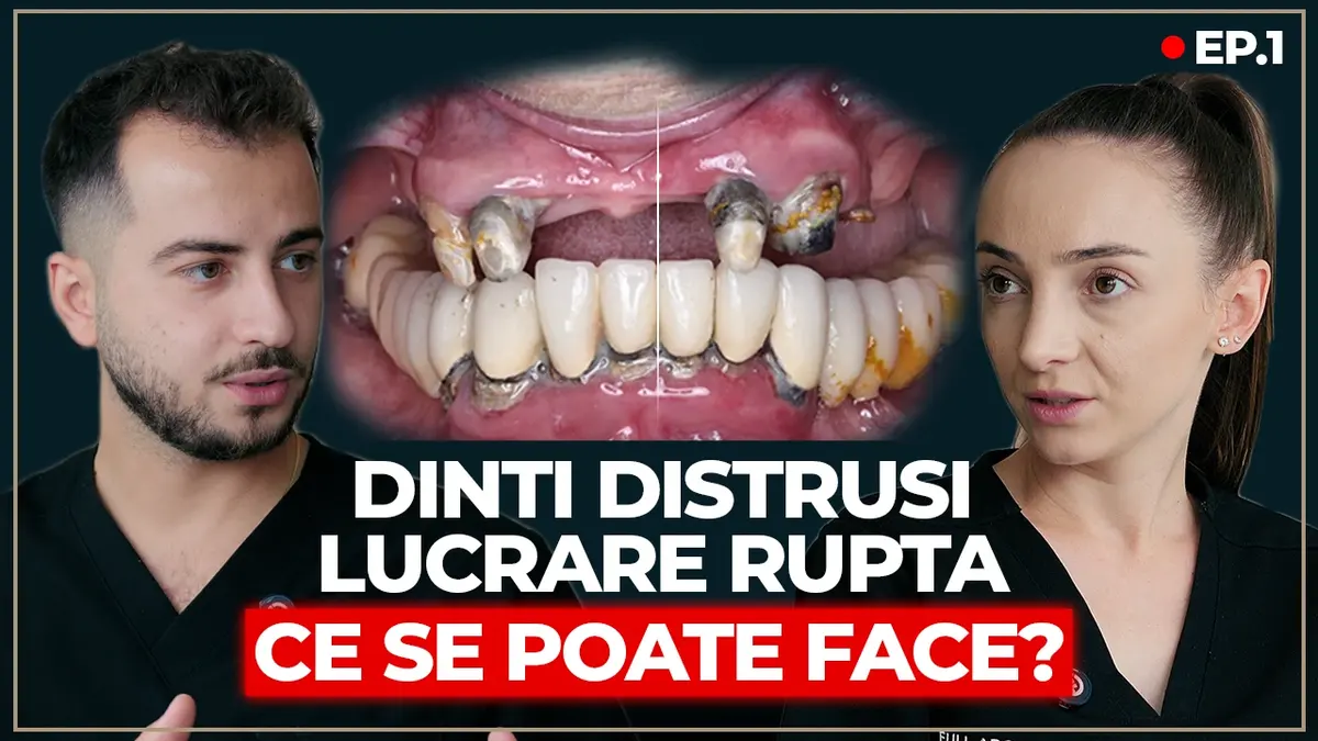 Ce se poate face atunci când lucrările vechi cedează: reabilitare completă pe implanturi