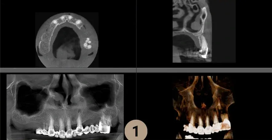 Secțiuni CBCT, radiografie panoramică și reconstrucție 3D, folosite la planificarea implantului