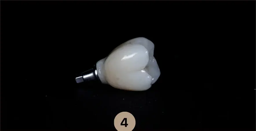 Coroana din ceramică fixată pe bontul protetic, fotografiată în laboratorul clinicii