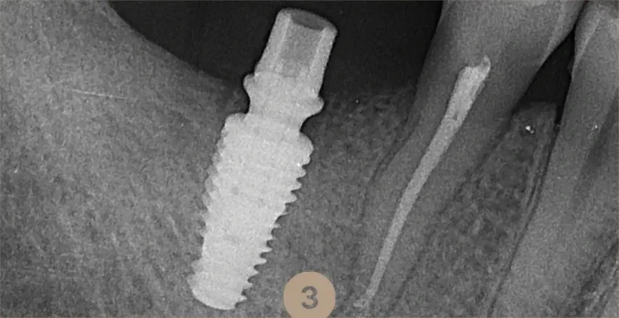Radiografie cu implantul dentar inserat în os, alături de rădăcina unui dinte natural