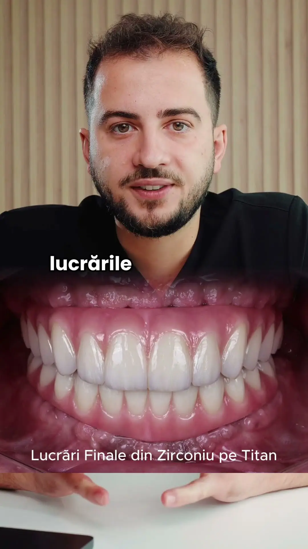 Cum a trecut de la proteză mobilă la lucrare fixă, la maxilar