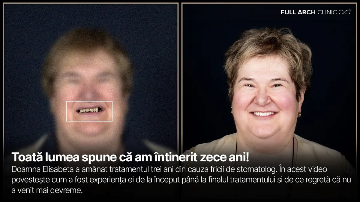 „Toată lumea spune că am întinerit zece ani”. Refacere completă pe nouă implanturi.
